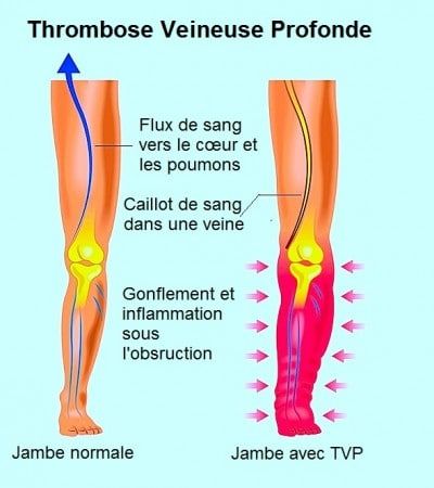 mal-aux-jambes-7.jpg