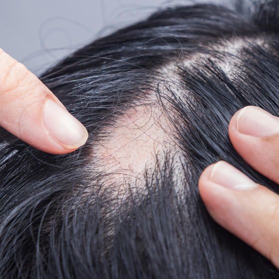 alopecie